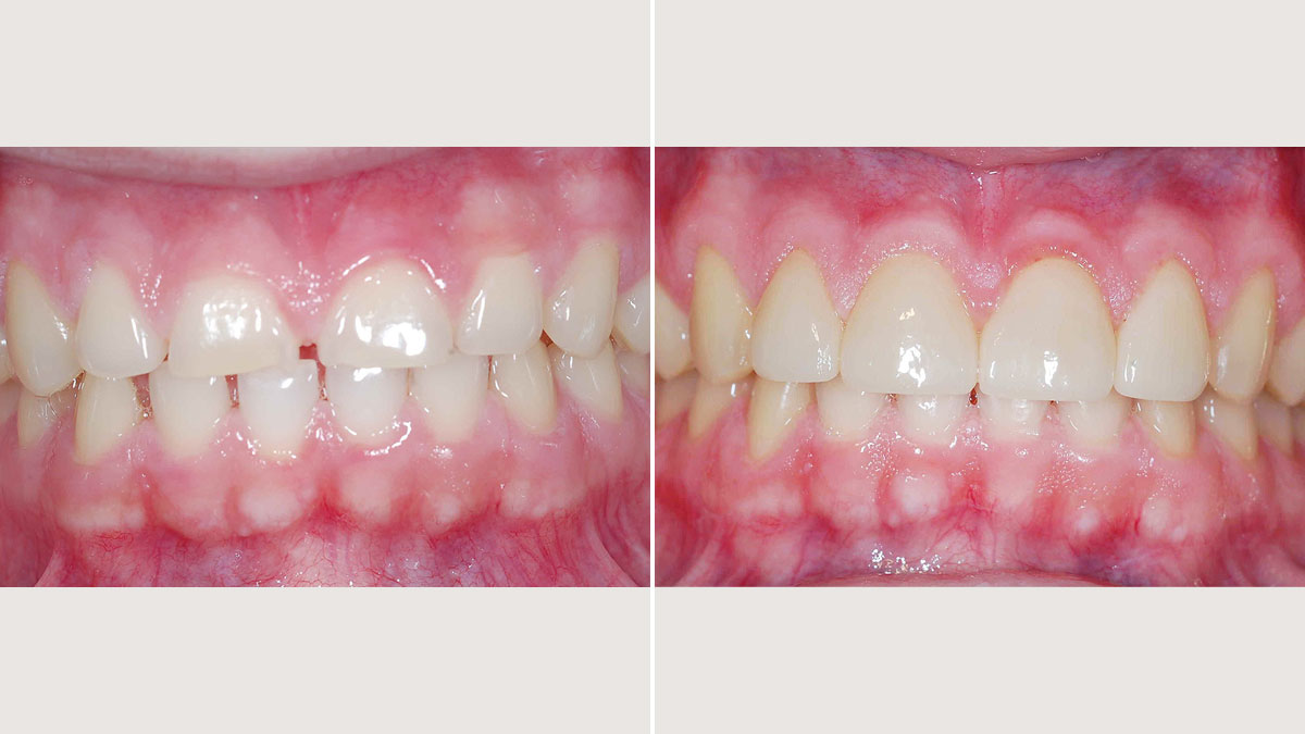 Esthetic crown lengthening and veneers