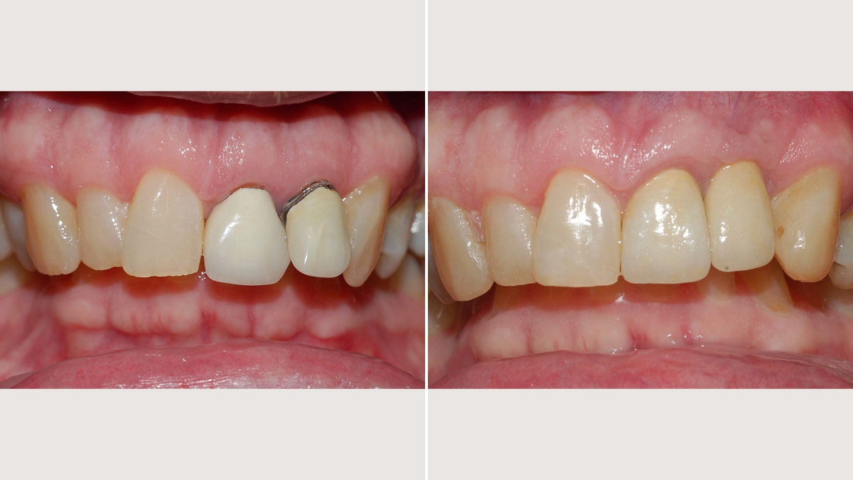 Lateral incisor replaced by implant supported crown and new crown on central incisor