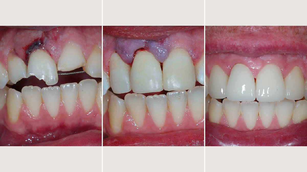 Initial Emergency Composite restorations, with final restorations completed with Emax crowns