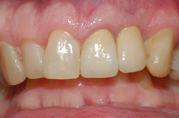 balanced gum line and longer looking teeth after cosmetic gum contouring treatment