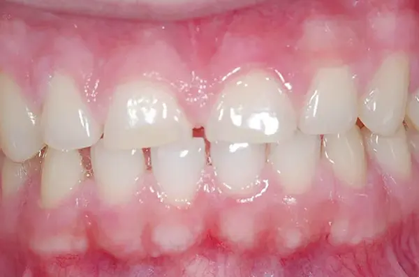 chipped and worn front teeth before dental bonding restoration
