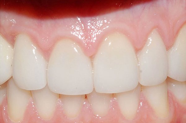 clean back teeth restored with tooth-colored composite dental fillings