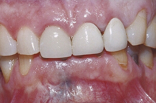 crooked and crowded lower teeth before clear aligner orthodontic therapy