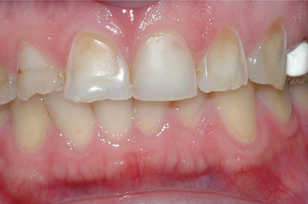 damaged and broken tooth structure before dental crown placement