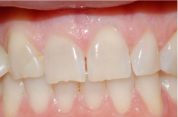 dark metal amalgam fillings in back teeth before white composite replacement