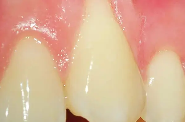 discolored and yellowed teeth before professional teeth whitening treatment