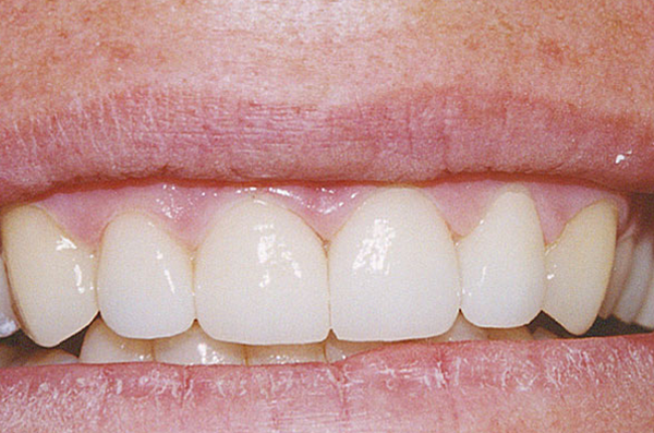 front incisor gap completely closed and blended using tooth-colored composite bonding