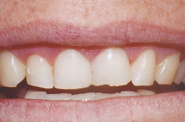 front incisors before cosmetic composite dental bonding