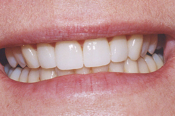 front teeth after custom porcelain veneers