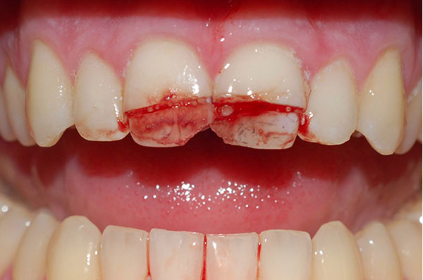front teeth before full mouth rehabilitation