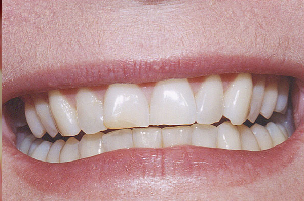 front teeth before getting porcelain veneers fitted