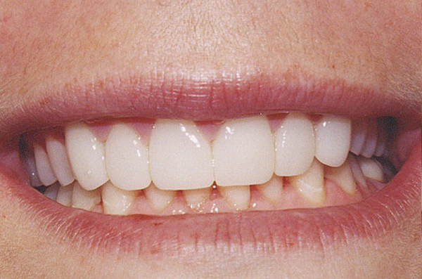 fully restored bite and complete row of teeth after dental bridge placement