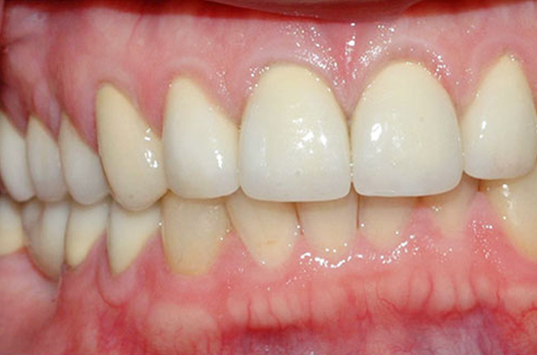 fully restored tooth look with a natural-looking custom porcelain dental crown