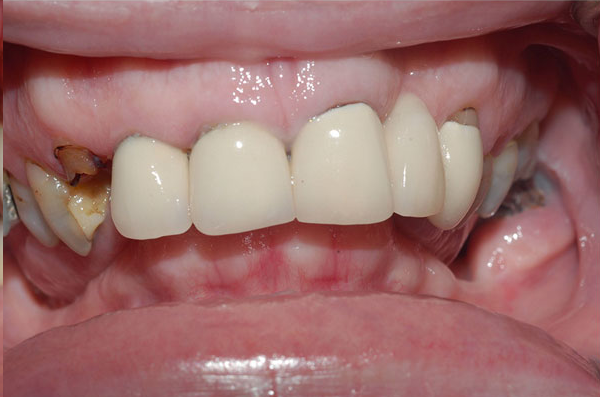 missing front tooth showing an empty space before a dental implant