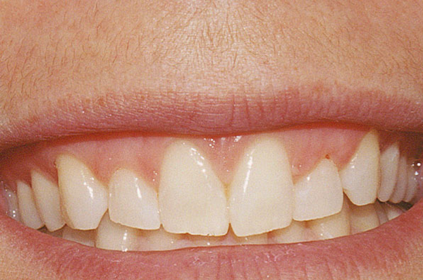 multiple missing teeth and advanced wear before receiving a custom dental bridge
