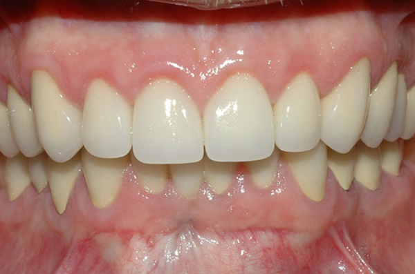 perfectly aligned and straight lower teeth after completing clear aligner therapy