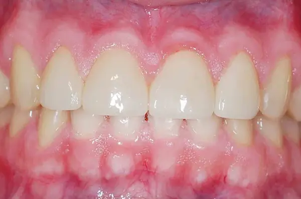 restored and smooth front teeth after dental bonding treatment
