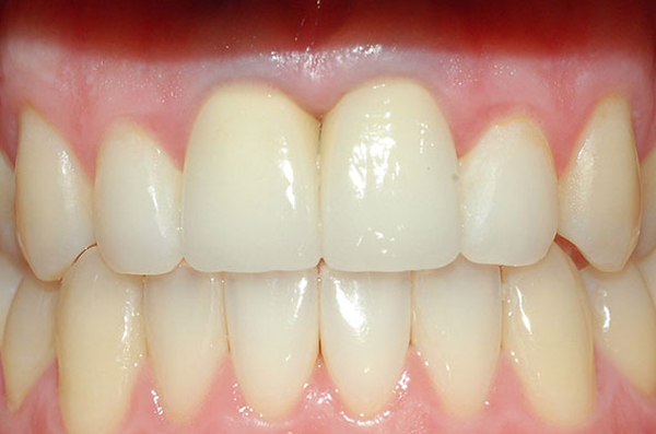 smile after full mouth cosmetic porcelain veneer restorations