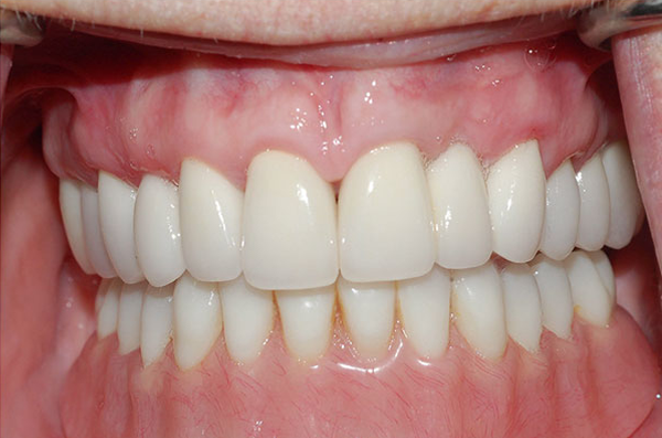 smile with a missing tooth replaced by a natural-looking dental implant crown