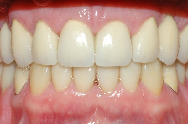 smile with gaps completely closed after dental treatment