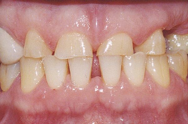 spaced and gapped teeth before orthodontic or restorative dental care