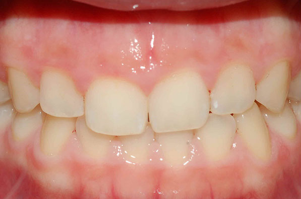 stained and misaligned teeth before cosmetic dental treatment