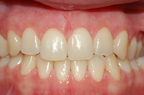 straight, white teeth after porcelain veneers and smile makeover
