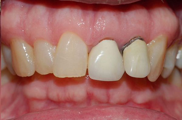 uneven gum line and short teeth showing a gummy smile before laser gum contouring