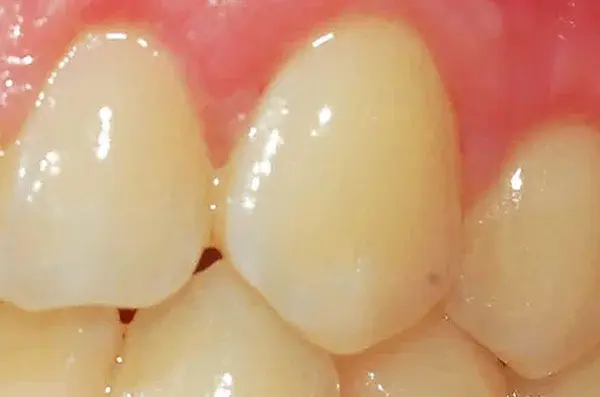 whitened and radiant teeth after a professional in-office whitening session